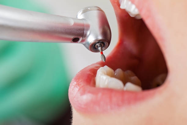 Best Emergency Dental Care for Abscessed Tooth in Jones Creek, TX